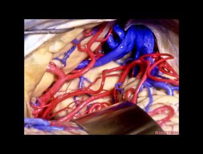 Navigating the Ventricles