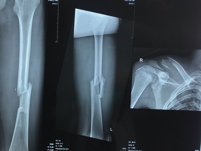 What do u think about this xray pict?