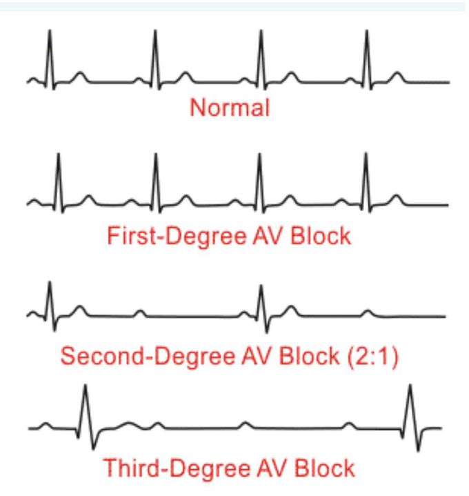 3 degree  av