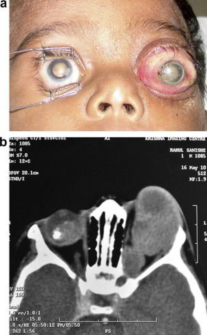 Retinoblastoma