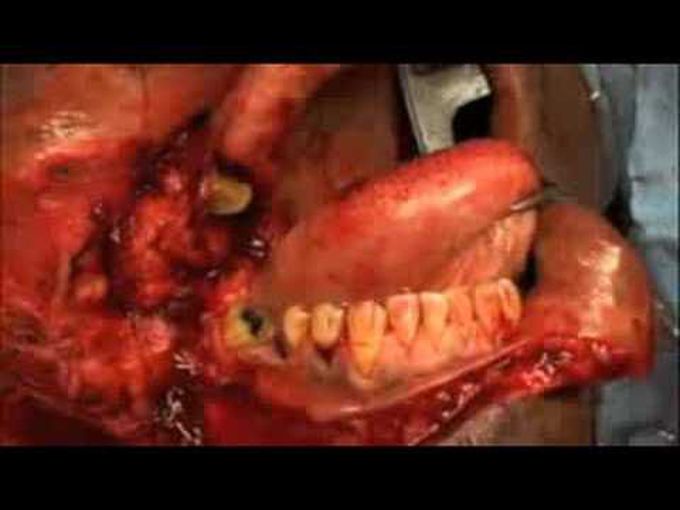 The Submental Island Flap