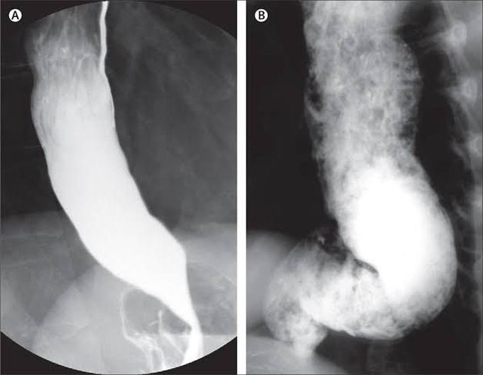 Causes of achalasia