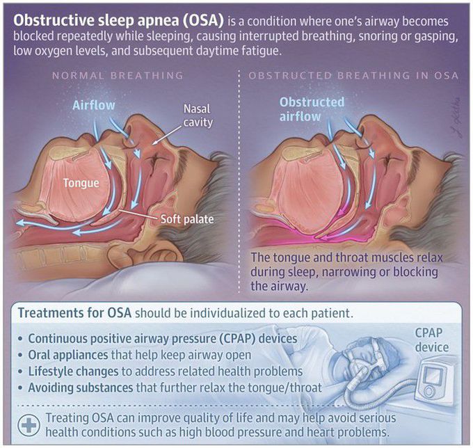 Obstructive Sleep Apnea