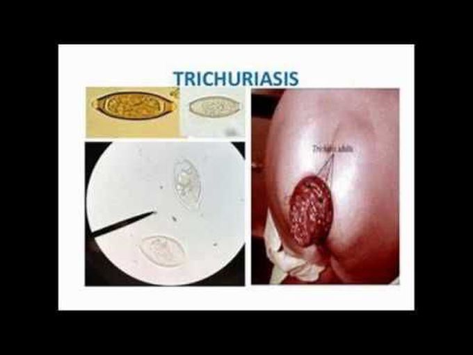 Trichuris trichiura