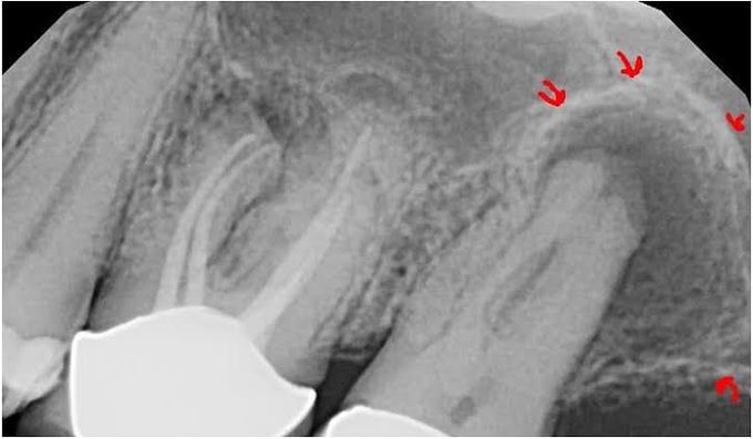 Causes of periapical granuloma