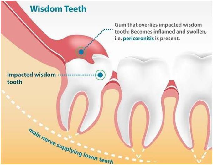 Pericoronitis