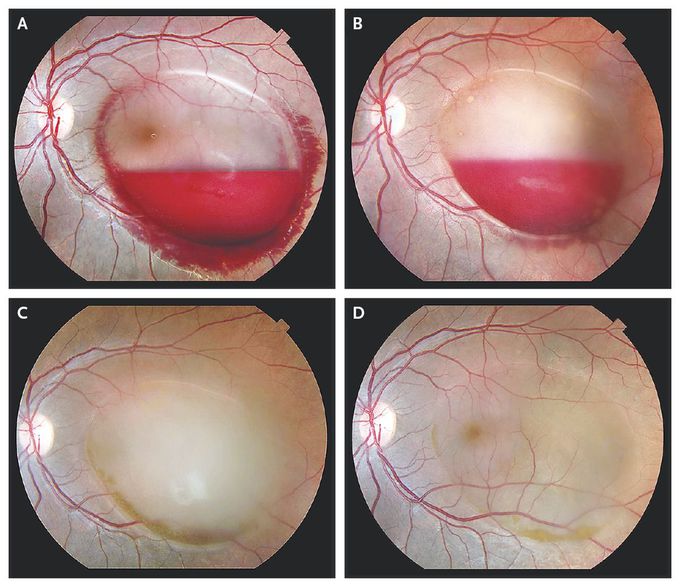 Valsalva Retinopathy