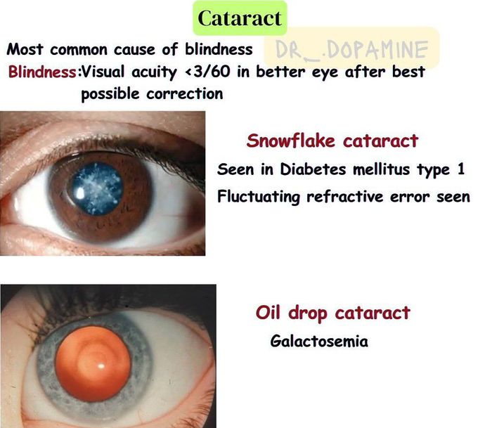 Cataract