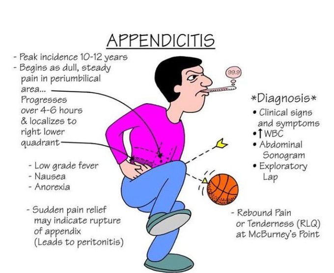 Appendicitis