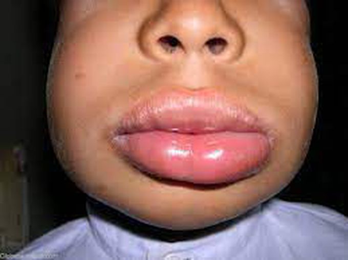 Angioedema