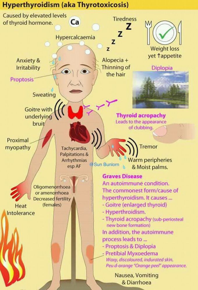 Hyperthyroidism