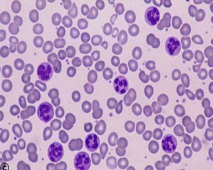 What kind of anemia you can see in this PBS??