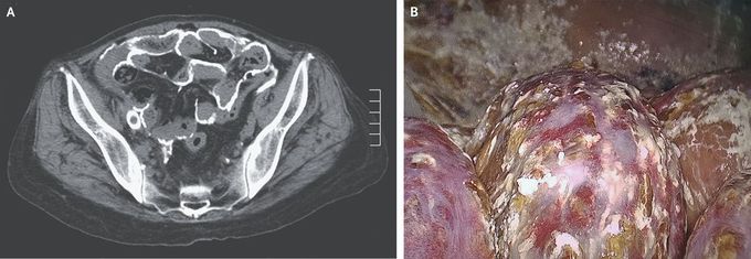 Encapsulating Peritoneal Sclerosis