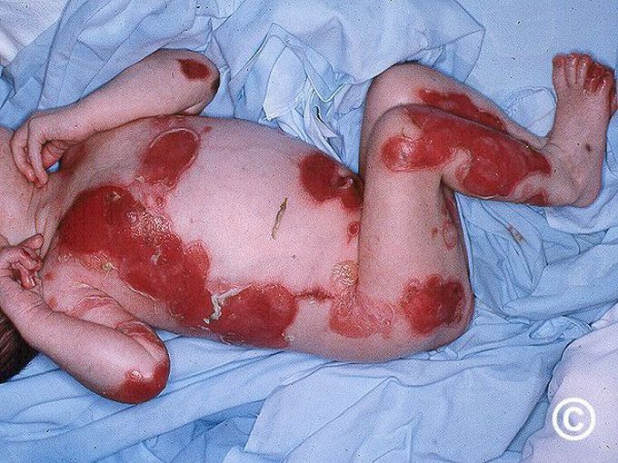 Causes of Epidermolysis Bullosa