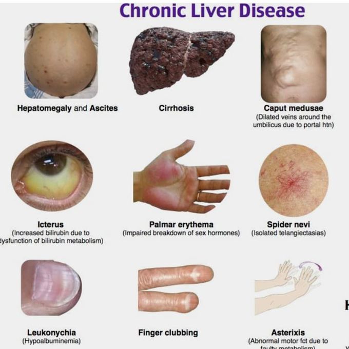 Chronic liver disease