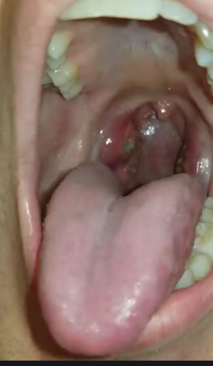 Tonsils that won't be looked at for another 4 weeks.