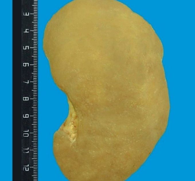 Amyloidosis of the kidney is a kidney disease that develops due to the deposition in them of a characteristic substance - amyloid.  Causes of kidney amyloidosis

 The main causes of the disease are: burdened heredity - familial amyloidosis, syphilis, tuberculosis, age-related changes, osteomyelitis, primary amyloidosis, which occurs without cause;  oncological diseases.

 Symptoms of kidney amyloidosis

 The patient has a general weakness, fatigue, headache, the appearance of edema in the legs, arms, face;  there is an increase in blood pressure, nausea, diarrhea, heart rate is disturbed, the size of the liver and spleen increase significantly, there are pain in the muscles and joints.  Depending on the form of amyloidosis and the cause of its cause, the degree of symptomatic manifestations may vary.

 DISEASES

 Kidney amyloidosis: causes of the disease, main symptoms, treatment and prevention

 ￼

 Causes of kidney amyloidosis Symptoms of kidney amyloidosis Diagnosis of kidney amyloidosis Treatment of kidney amyloidosis Prevention of kidney amyloidosis

 Kidney disease develops due to the deposition of a characteristic substance in them - amyloid.

 Causes of kidney amyloidosis

 The main causes of the disease are: burdened heredity - familial amyloidosis, syphilis, tuberculosis, age-related changes, osteomyelitis, primary amyloidosis, which occurs without cause;  oncological diseases.

 Symptoms of kidney amyloidosis

 The patient has a general weakness, fatigue, headache, the appearance of edema in the legs, arms, face;  there is an increase in blood pressure, nausea, diarrhea, heart rate is disturbed, the size of the liver and spleen increase significantly, there are pain in the muscles and joints.  Depending on the form of amyloidosis and the cause of its cause, the degree of symptomatic manifestations may vary.

 Read:

 How to properly prevent kidney disease

 Diagnosis of kidney amyloidosis

 The analysis of the medical history of the disease, anamnesis of life, the collection of patient complaints.  A general analysis of blood and urine, biochemical analysis of blood, if necessary, a biopsy of the kidneys, genetic analysis.  Informational method is computed tomography of the kidneys.  Consultation of the nephrologist is necessary.

 Treatment of kidney amyloidosis

 Specific methods of therapy have not been developed, since the mechanism of the development of the disease is not completely clear.  Patients should be treated for the underlying disease, which led to the development of amyloidosis, eat regularly and fractionally, more easily, for absorption by the body, food.  Acceptance of diuretic drugs, anabolic steroids (Nerobol, Methandrostenolone, Dianabol).  If necessary, the "artificial kidney" method is used; in more severe cases, a kidney transplant may be needed.

 Possible complications: chronic renal failure, there is a risk of death.

 Prevention of kidney amyloidosis

 It is necessary to ensure timely treatment of such diseases as tuberculosis, rheumatoid arthritis, syphilis, as well as other serious and dangerous diseases.  Adhere to a healthy lifestyle, eat fully, exercise regularly.  It should stop smoking, alcohol, drugs.  Exclude uncontrolled medication.