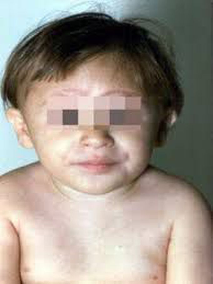 Symptoms of fanconi anemia
