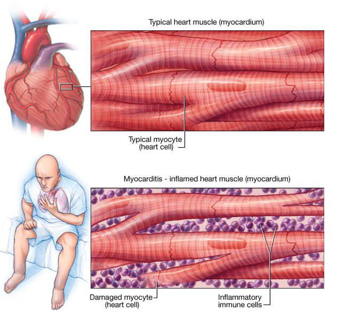 Myocarditis