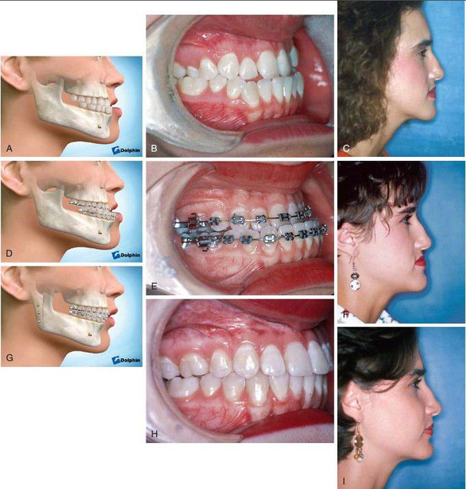 Class III malocclusion treatment