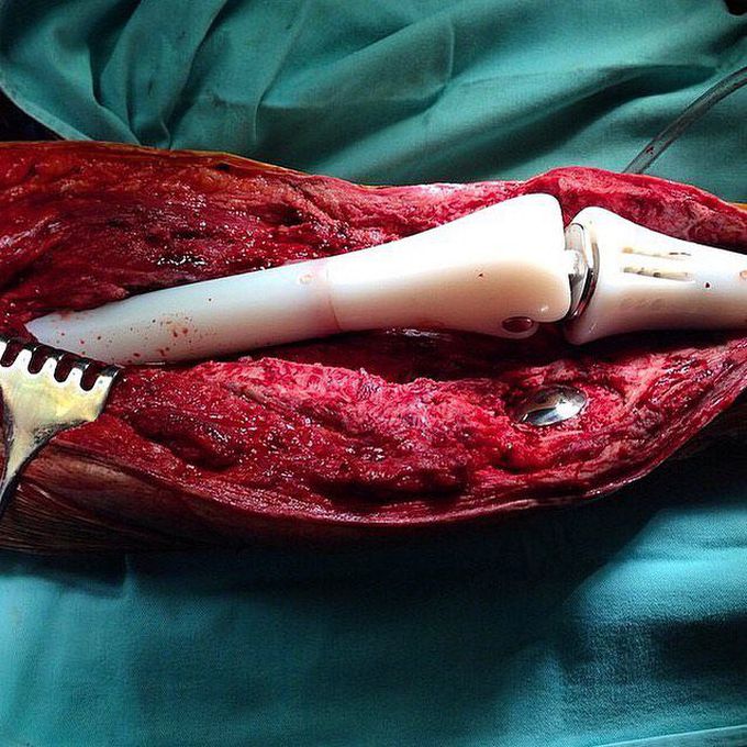 Prosthetics femur and tibia replacements due to an osteosarcoma of the bone!! 🦴⁣ 