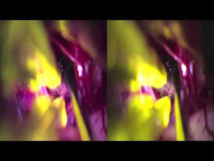 Resection of pontine cavernous malformation through the pontomedullary sulcus (3D)