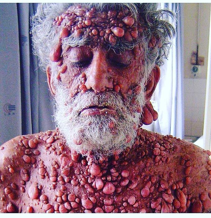 Neurofibromatosis