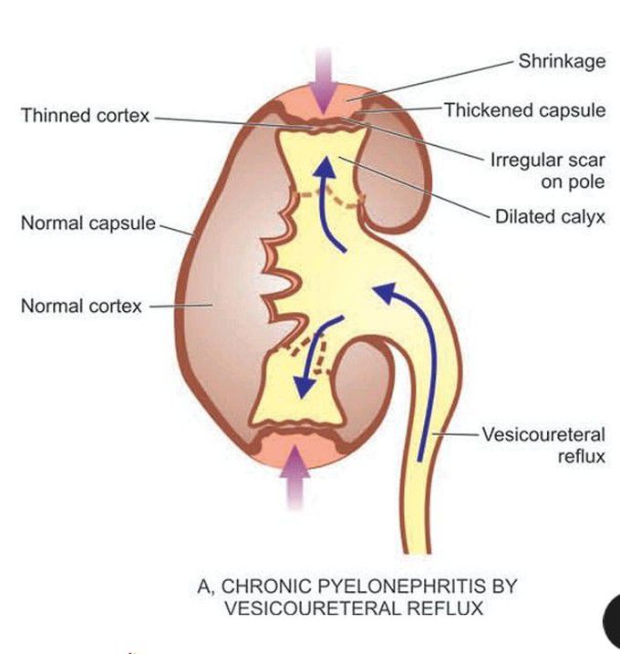 Chronic pyelonephritis