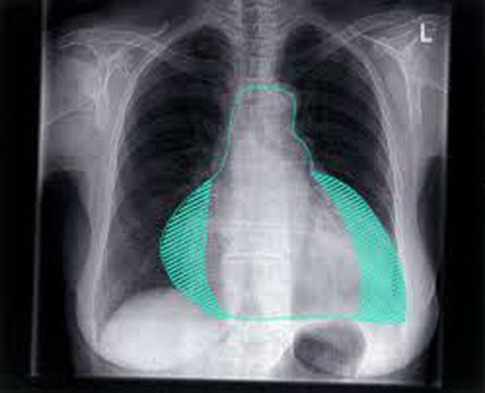 Pericardial effusion