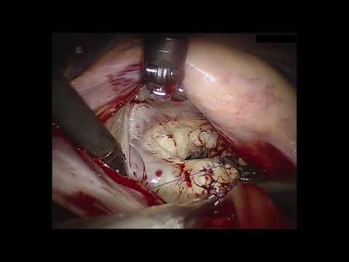 Mitral Valve Repair: Five Techniques for 95% Repair