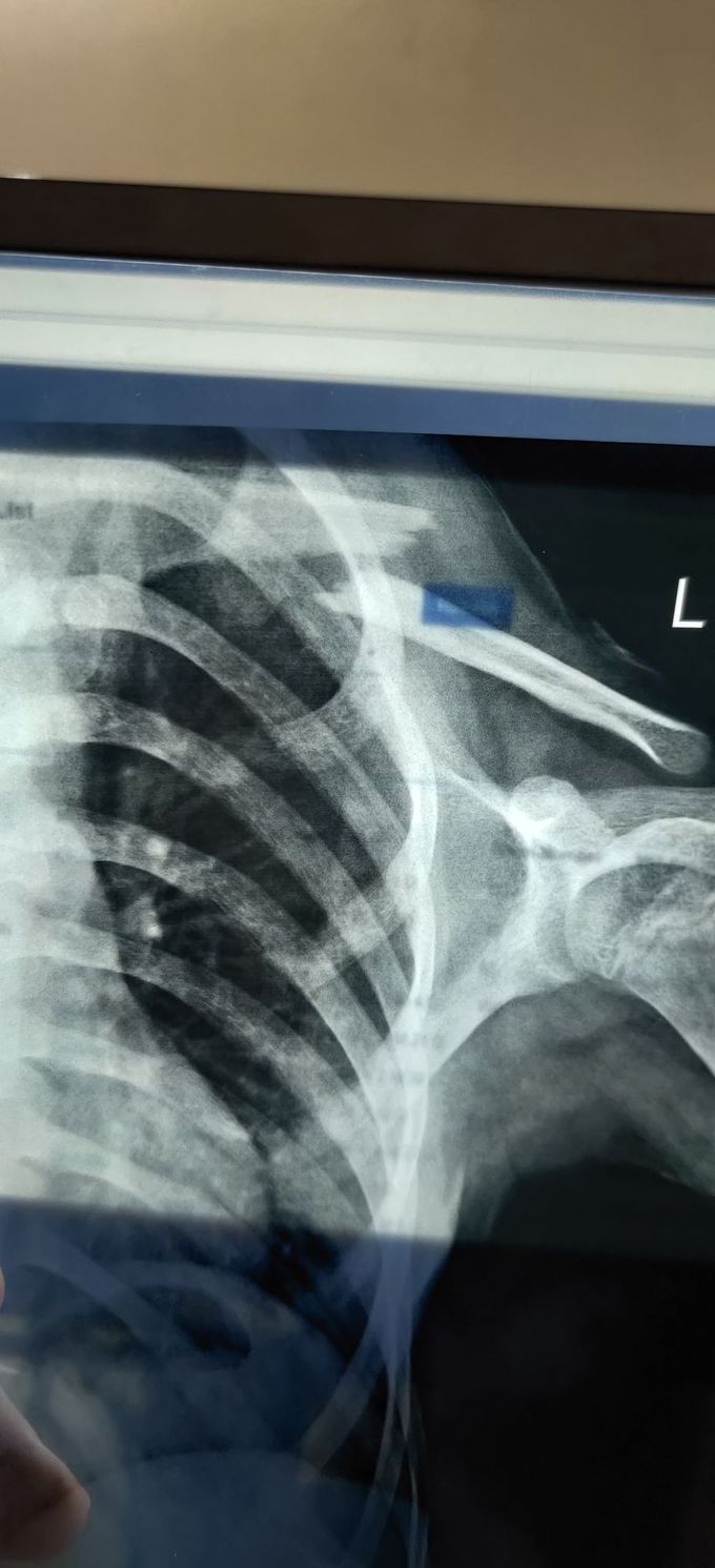 L Clavicle Fracture