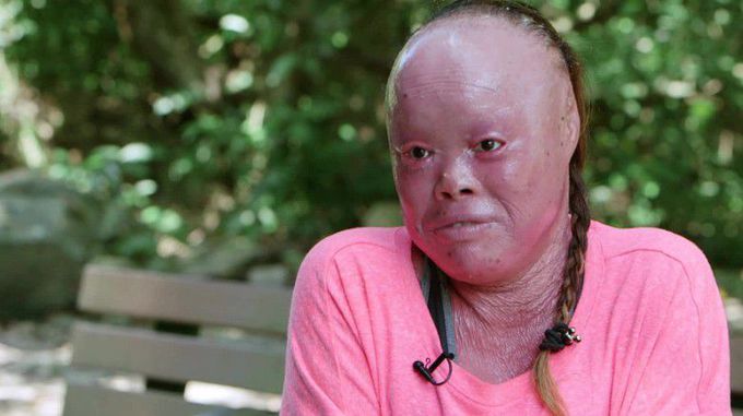 Image: Mui Thomas battles skin disorder harlequin ichthyosis - CNN