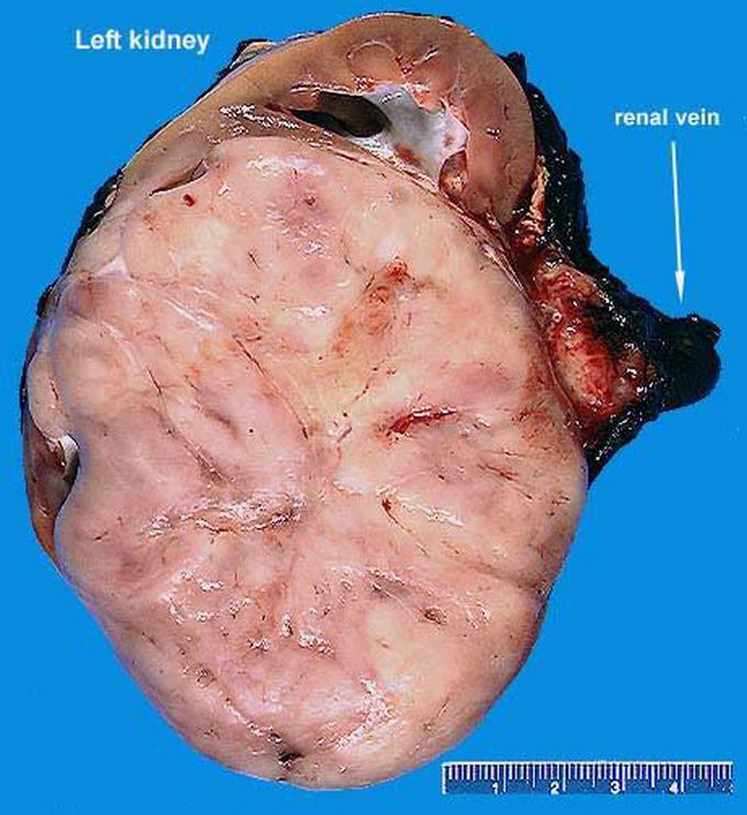 Renal Sarcoma