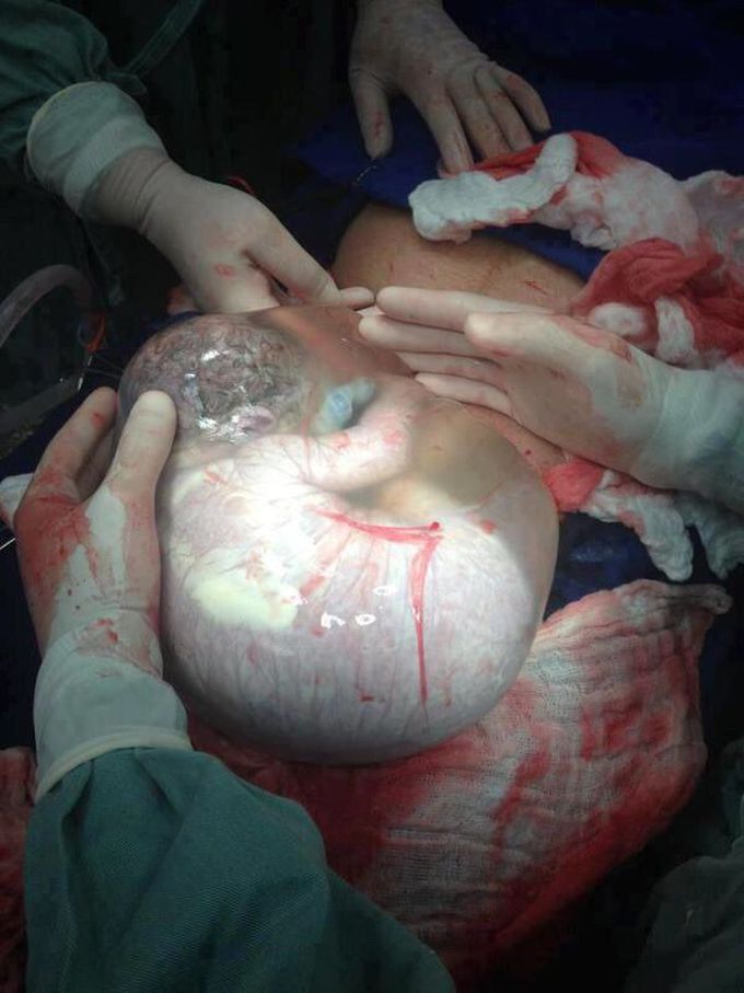 Cesarean section with placenta still intact