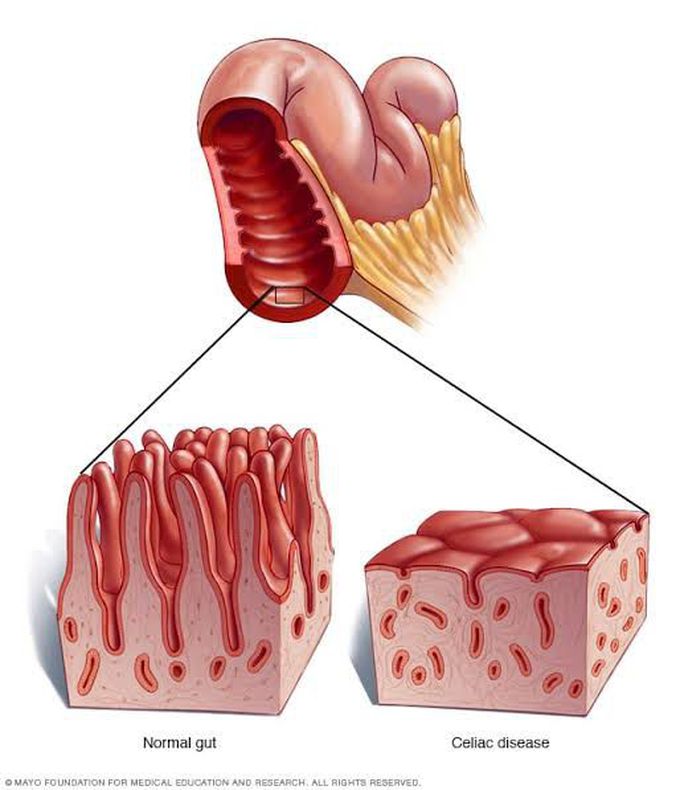 treatment-of-celiac-disease-medizzy