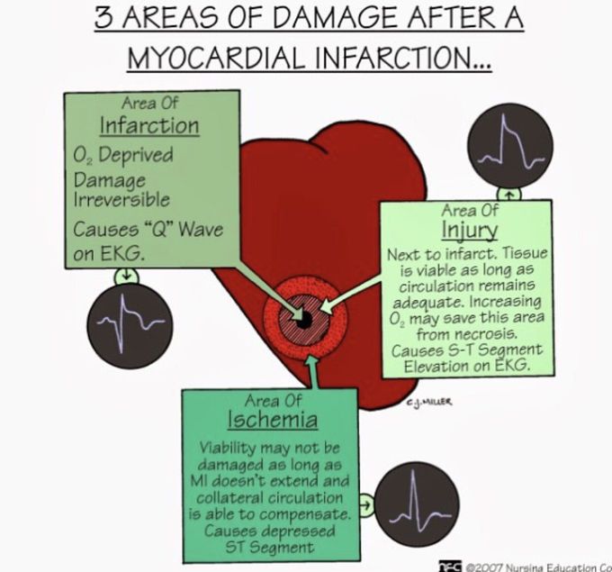 All about myocardial infraction