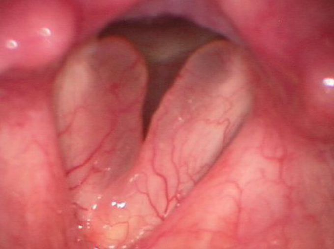 Reinke's Edema