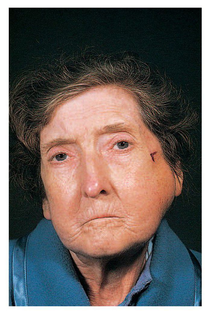 Metastatic carcinoma of the mandible.
