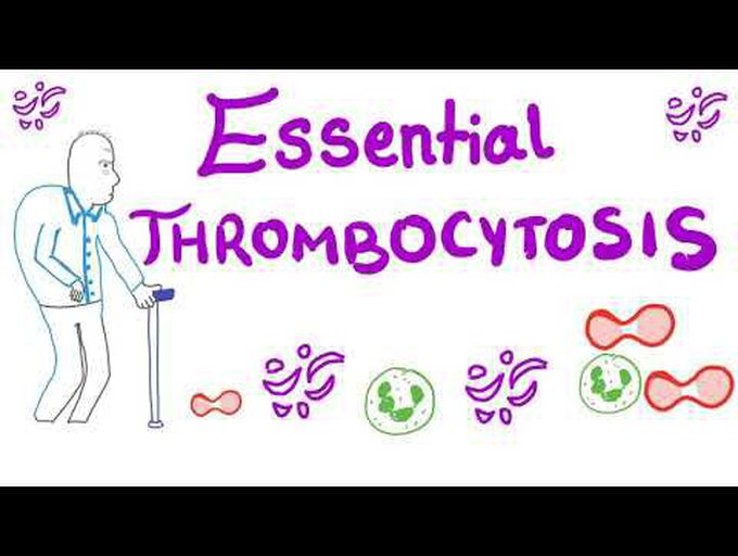 Pathology of Essential Thrombocytosis