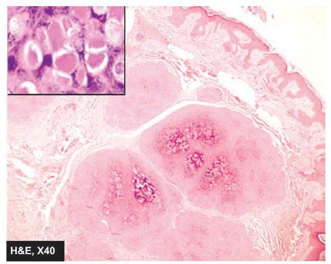 Molluscum contagiosum.