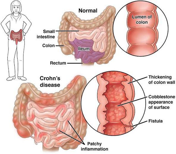 Treatment of crohn's disease