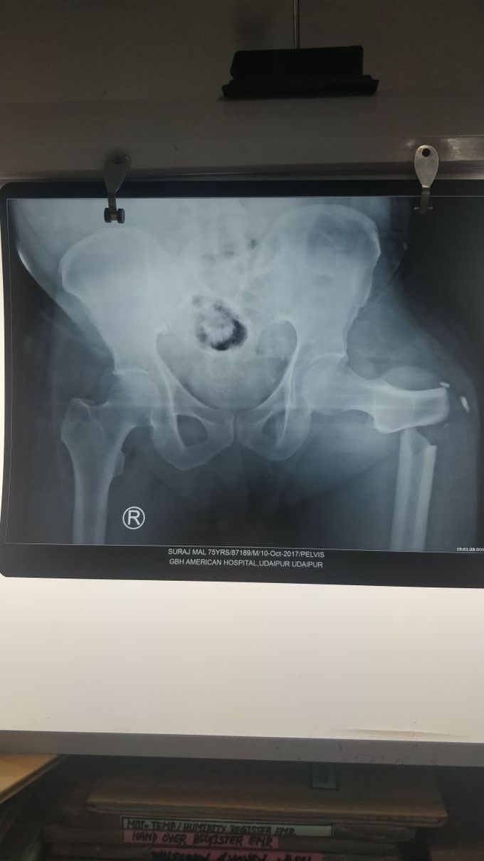 Fracture