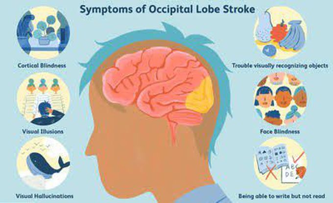 These are the symptoms of Occipital lobe stroke