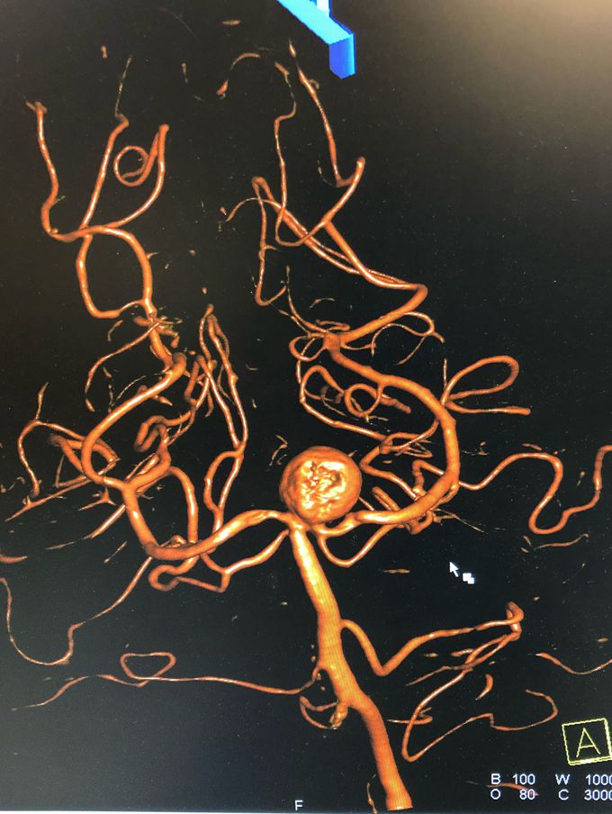Saccular basilar aneurysm