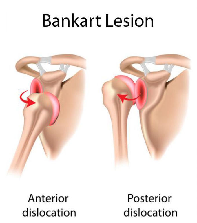 Cause of Bankart Lesion