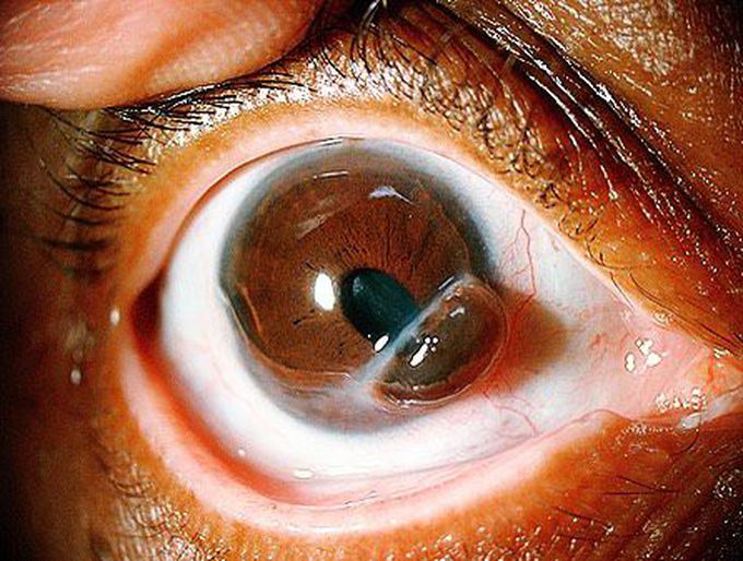 A corneal perforation with prolapsed iris!!!