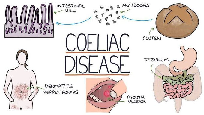 Coeliac disease