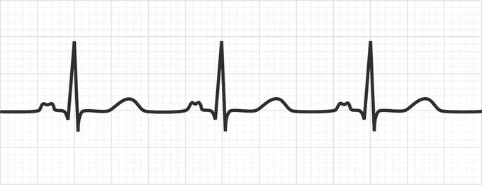 Bifid P Waves AKA P Mitrale