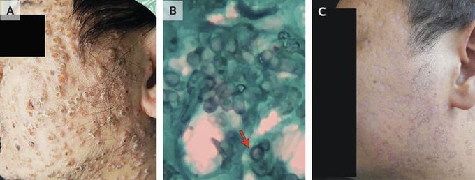 Talaromyces marneffei Infection