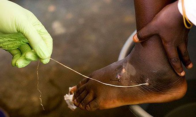 Dracunculiasis aka Guinea Worm Disease
